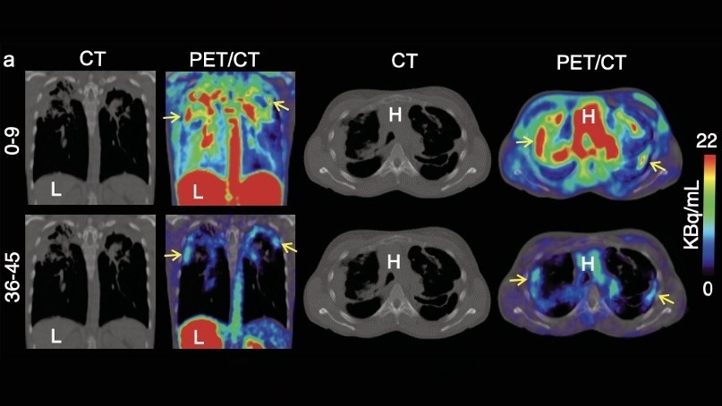 Image: The diagnostic tool could improve diagnosis and treatment decisions for patients with chronic lung infections (Photo courtesy of SNMMI) Image: The diagnostic tool could improve diagnosis and treatment decisions for patients with chronic lung infections (Photo courtesy of SNMMI)